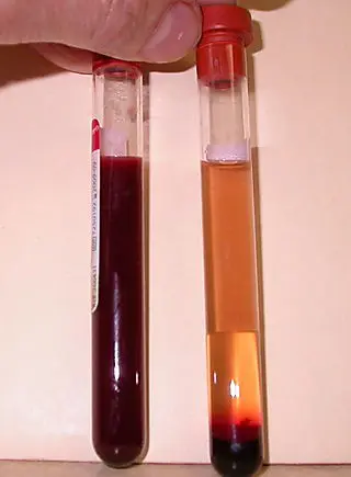Urine bloody (2)